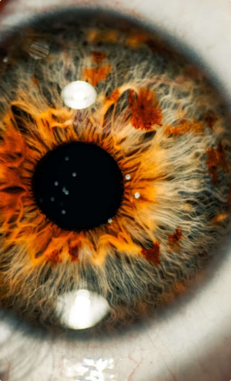Close up of an eye and iris with white spots on it which could indicate eye surgery is needed