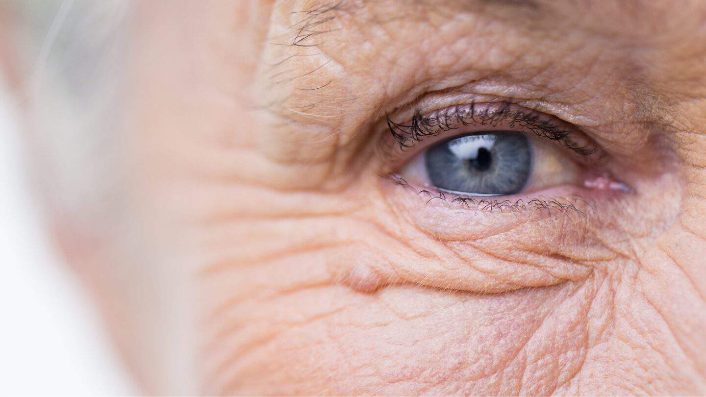 Cataracts Sapphire Eye Care